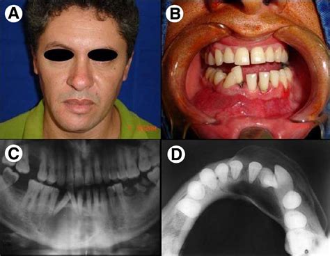 Anterior Mandibular Swelling Journal Of Oral And Maxillofacial Surgery