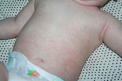 Skin Rash In Babies