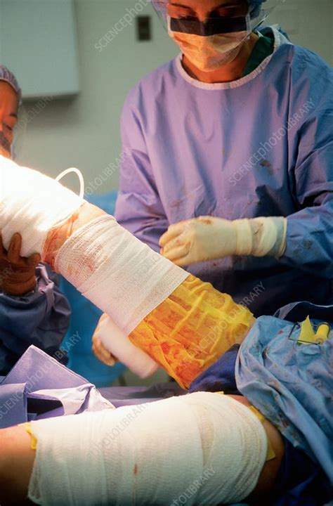 Wrapping Leg Of Burn Patient Stock Image C0048215 Science Photo
