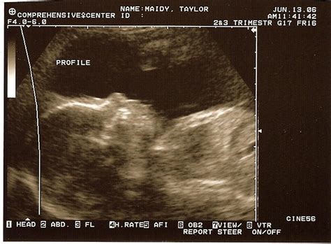 The Maidy Boys 25 Weeks Ultrasound 3