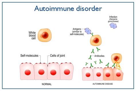 Autoimmune Disease Types Symptoms Causes Treatment