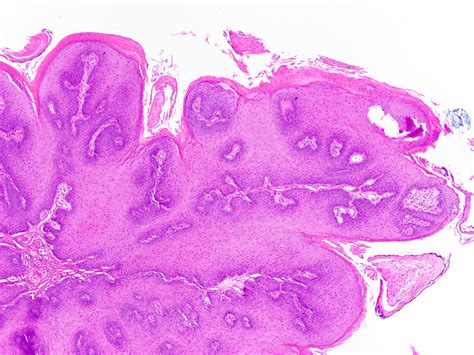Human Papilloma Lesion Human Papillomavirus Positive Squamous Cell