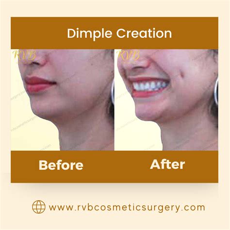 Dimple Creation Philippines Procedure Candidates And Results