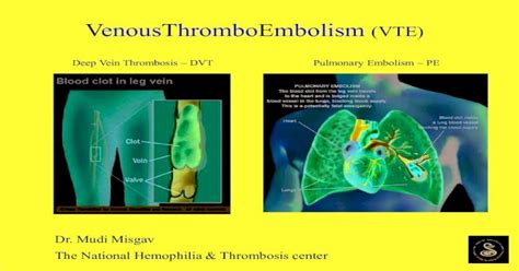 Thrombophilia And Cardiovascular Diseasedeep Vein Thrombosis Dvt