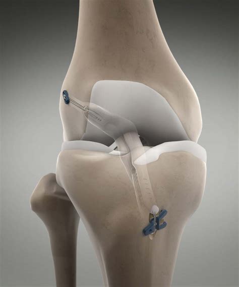 Dr Reish Completes The First N8tive Acl Reconstruction In New York