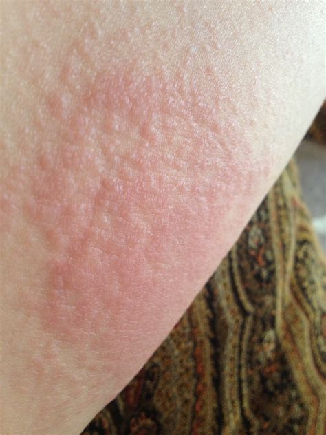Itching Legs With No Rash