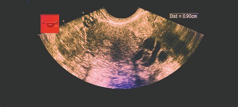 what to do with incidental ovarian cysts pulse today