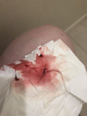See more ideas about spotting during pregnancy, pregnancy, pregnancy symptoms. Bleeding in my 7th week - August 2019 Birth Club ...