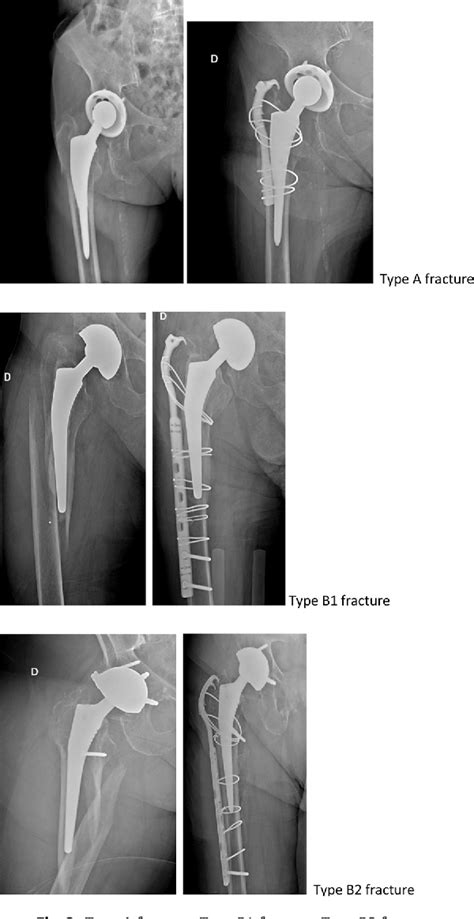 Figure 3 From Osteosynthesis Of Periprosthetic Type A And B Femoral