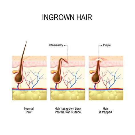Ingrown hair also often develop in armpit, on face, on legs and on arms. 5 Tips-Ingrown Hairs on Your Private Areas - HealthFaire.com