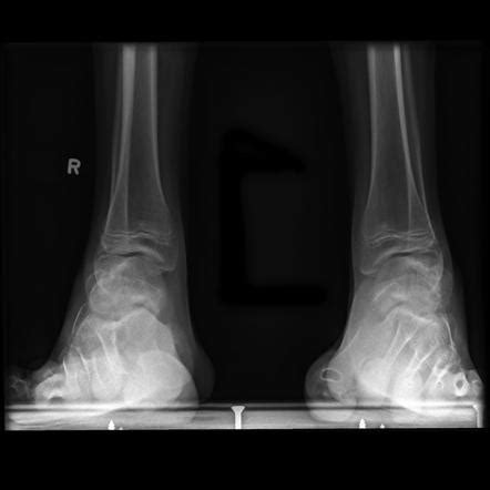 It occurs when there are mutations in the genes that affect the nerves in your feet, legs, hands and arms. Charcot-Marie-Tooth disease with pes cavus | Image ...