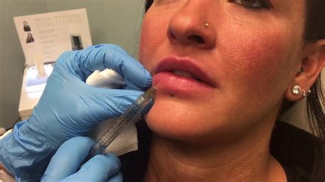 Wondering what lip injections cost? Juvederm Ultra Plus Lip Injections - YouTube