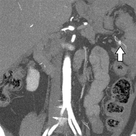 Rupture Of Splenic Artery Aneurysm Which Was Located Distally