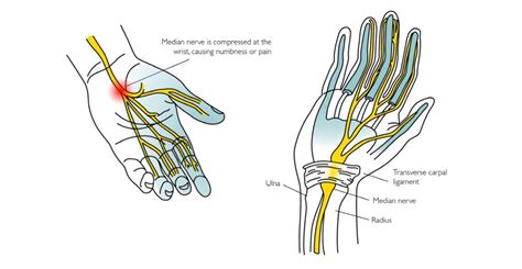 Carpal Tunnel Syndrome Soft Tissue Therapy Trigger Point Release Carpal Tunnel Syndrome