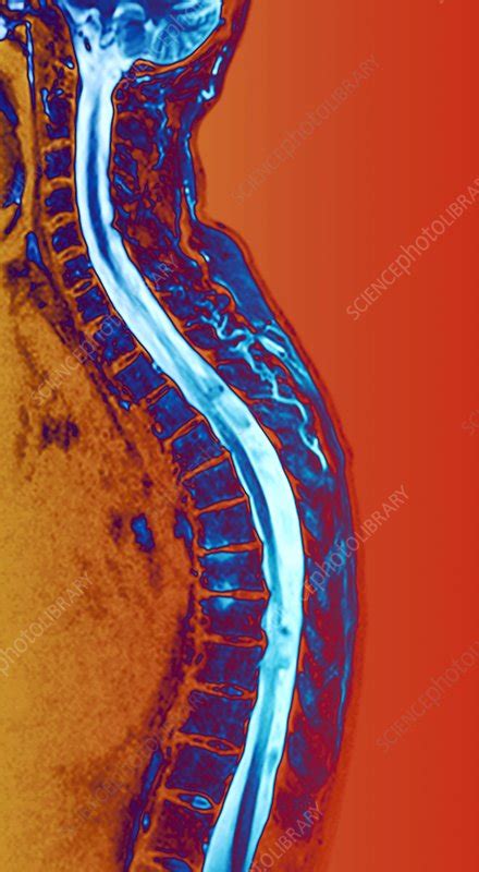 Curved Spine Mri Scan Stock Image C0215423 Science Photo Library