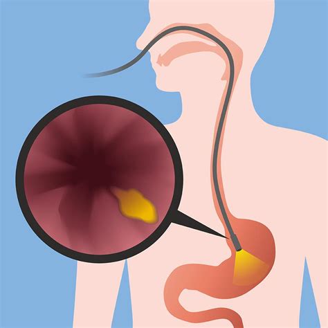 Gastroscopy Reflux Swallowing Center