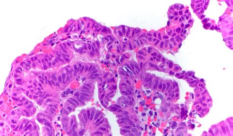Pathology Outlines Biliary Intraepithelial Neoplasia