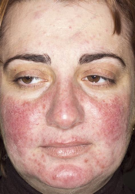 Acne Rosacea On The Face Stock Image C0142533 Science Photo Library