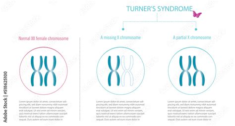 Turner Syndrome Representation Of XX Chromosomes With Total Or Partial