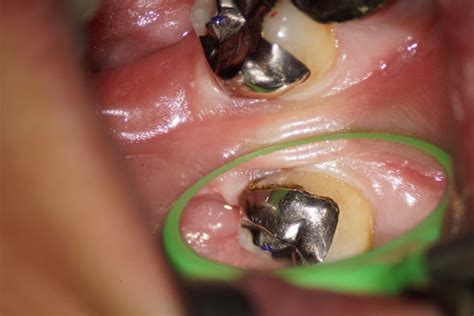 虫歯を放置―どうなる？自然と治ることはある？危険性について解説｜吉松歯科医院公式ブログ