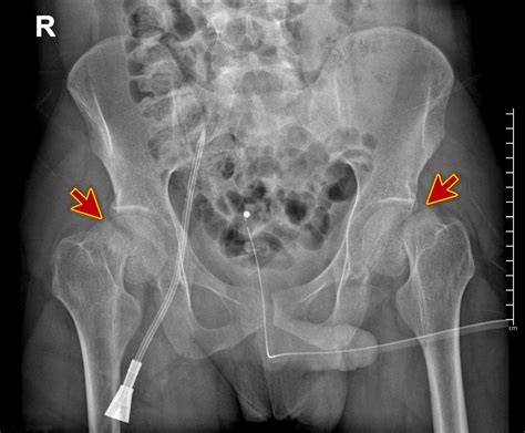 Human Female Pelvis X Ray