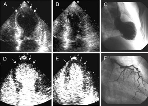 Takotsubo Cardiomyopathy Circulation