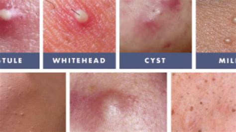 Milia How To Remove The Small White Skin Cysts Youtube