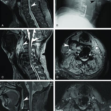 Sagittal Cervical Spine Mri A Showing Large C And C Disc Download Scientific Diagram