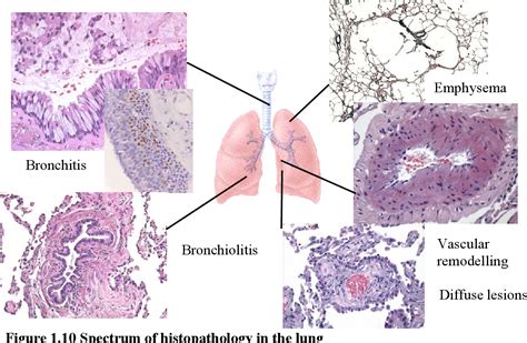 Pdf Histopathology Of Diffuse Lung Parenchyma Epithelial Metaplasia