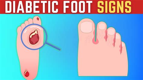 Diabetes Signs And Symptoms In The Feet 12 Ways To Prevent Diabetic Foot Problems Youtube