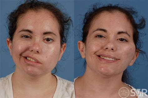 Facial Paralysis After Surgery Before And After Photo Gallery Dallas