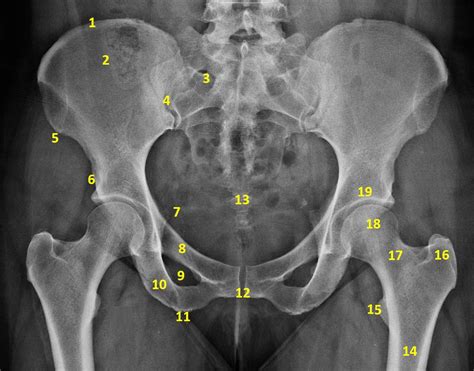 The pelvis is separated into two regions. Pelvic plain film anatomy. | Radiology, Pelvis, Radiography