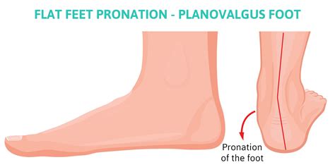 Flat Feet Pronation Complications From Overpronation