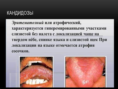 Полость рта. Соматические заболевания - презентация онлайн Картинка - Полость рта. Соматические заболевания - презентация онлайн