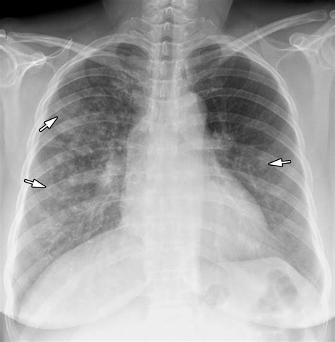 Radiographic And Ct Features Of Viral Pneumonia Radiographics