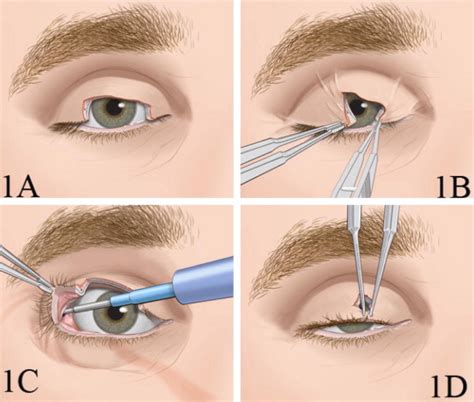 Illustrations Depict A Large Right Upper Eyelid Defect That Will Be