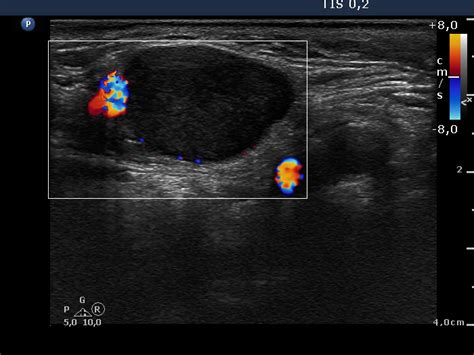 Lymph Nodes In The Neck