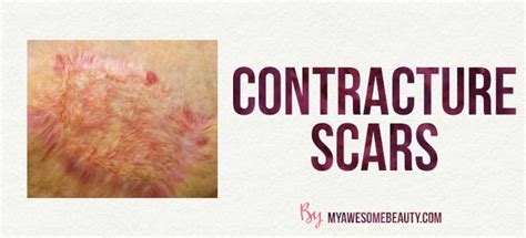 Scar Removal Treatments The Best Treatments With Pros And Cons