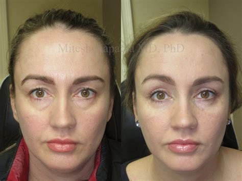 Upper And Lower Blepharoplasty Before And After Photos Boston Eyelids