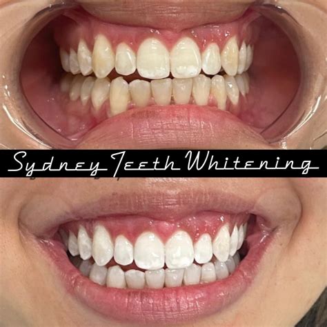 White Spots On Teeth After Teeth Whitening Sydney Teeth Whitening