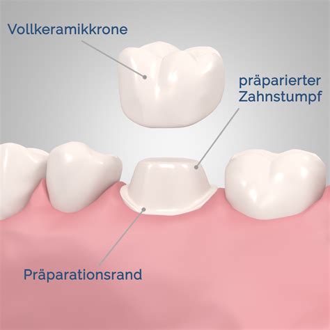 Kronen Und Brücken Zahnarztpraxis Leipziger14