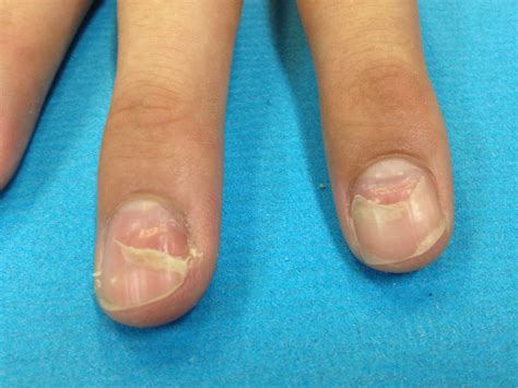 巻き爪の原因・予防・切り方・処置― 当院でのご説明について。 午前中の巻き爪矯正外来に来院されるようにお願い申し上げます。 その他の時間は診察の合間に行いますので、なるべく平日にご来院ください。。 ※ かわいい子供たちの画像: 驚くばかり子供 爪 剥がれ た