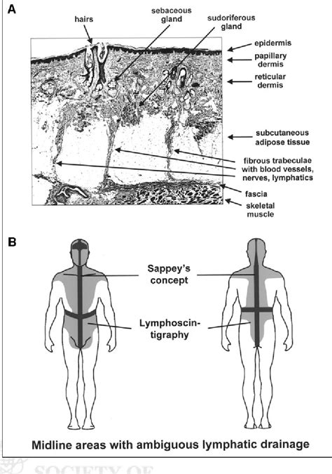 Figure 1 From Radioguided Sentinel Lymph Node Biopsy In Malignant