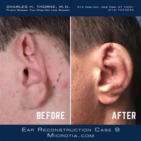 Microtia Ear Reconstruction Case 9 Before And After Microtia