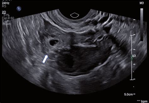 Ovarian Ectopic Pregnancy Transvaginal Ultrasound Showing A