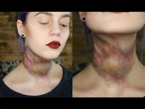 bruised neck from being choked