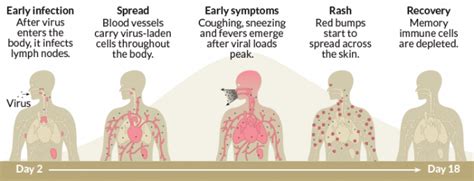 Measles Can Harm A Childs Defense Against Other Serious Infections