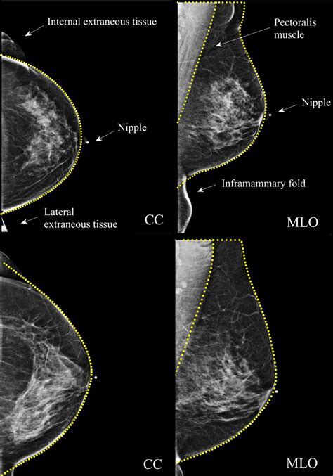 Pdf] Mammography Positioning Standards In The Digital Era 56 Off