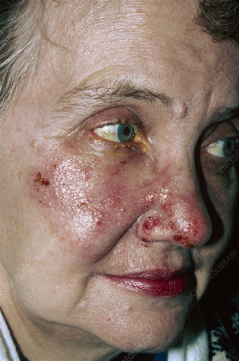 Herpes Zoster Blisters On Womans Face Stock Image M2600151