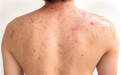 Back Acne And Body Acne Treatment Guide Singapore Edwin Lim Medical